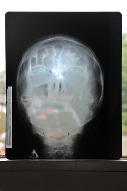 röntgenfoto st lucas antwerpen